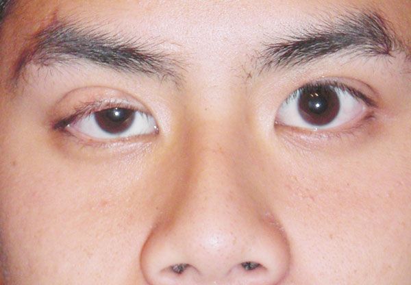 Ptosis Surgery in Amritsar