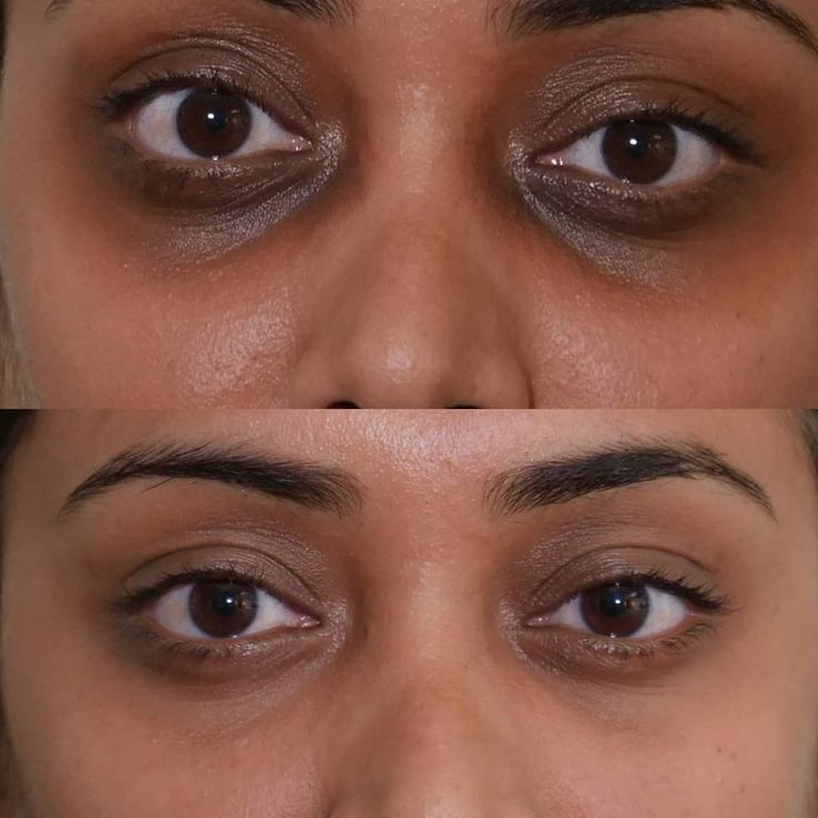 Ptosis Surgery in Amritsar