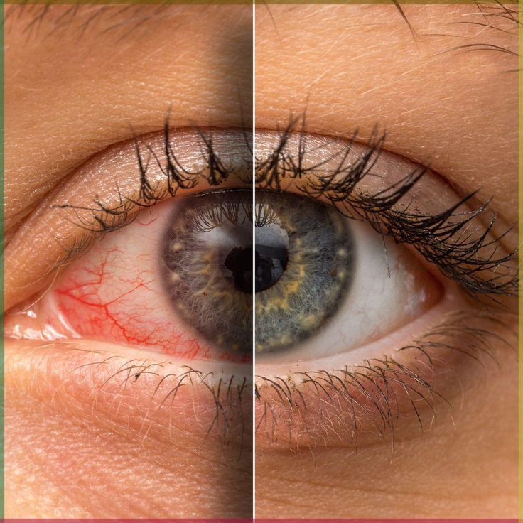 Dry Eye Treatment in Amritsar | Dry Eye Disease Clinic in Amritsar