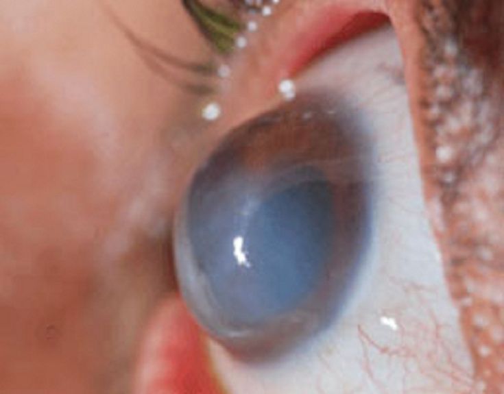 Keratoconus treatment Amritsar