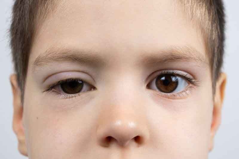Ptosis Surgery in Amritsar