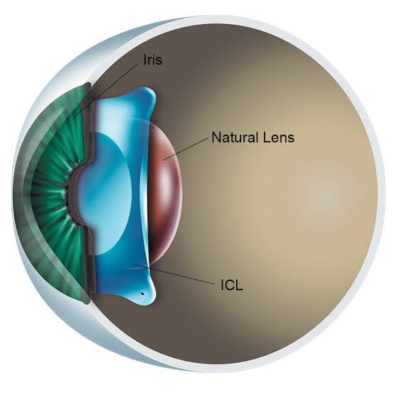 ICL Surgery in Amritsar
