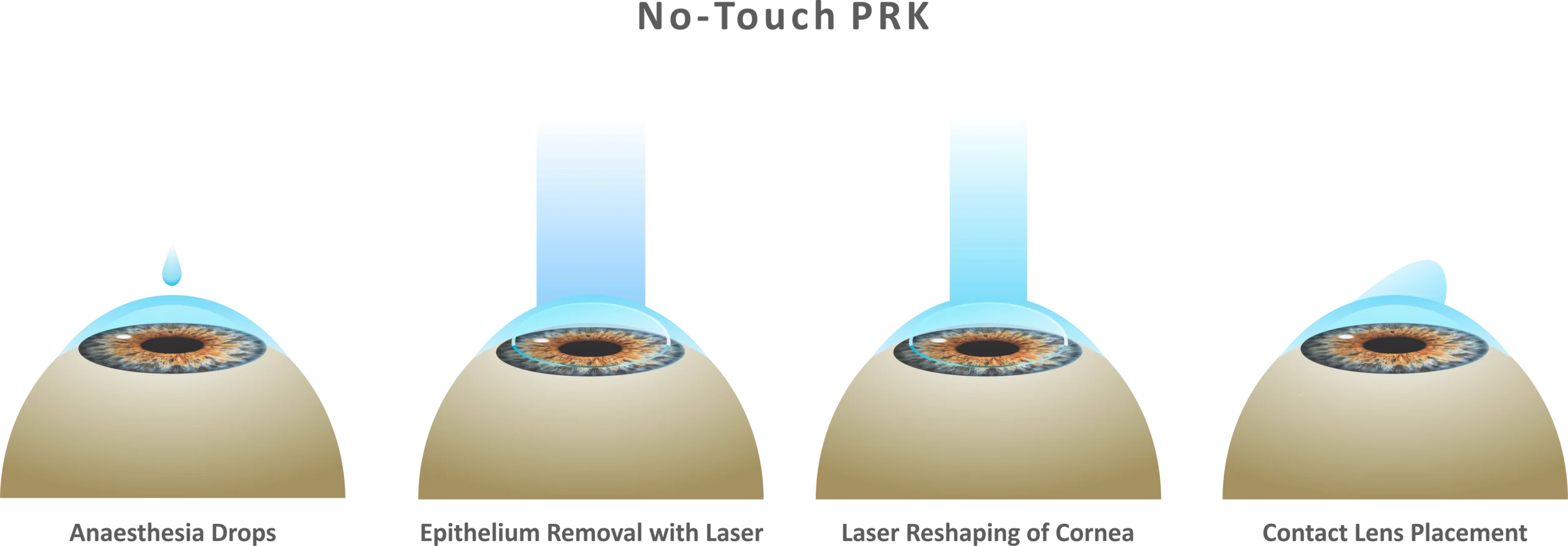 Wavelight PRK Surgery in Amritsar