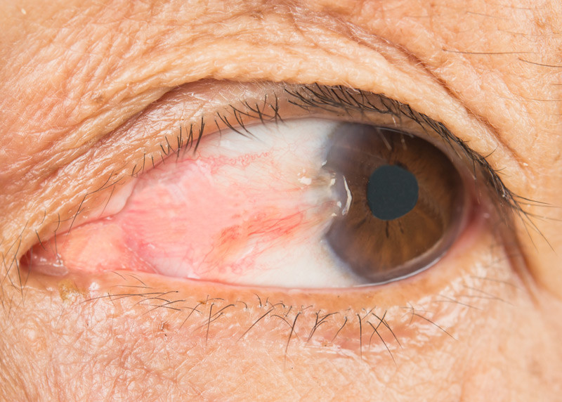 Pterygium Treatment in Amritsar | Dr. Daljit Singh Eye Hospital
